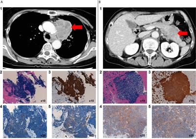 Case Report: Durvalumab-Associated Encephalitis in Extensive-Stage Small Cell Lung Carcinoma